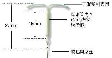 手臂避孕环的原理_避孕环的原理 避孕环的种类大盘点 图解 2