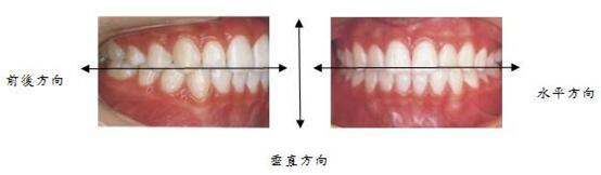 调整咬合,前面说的几种牙齿问题都会带来咬合不正,导致左右脸不一样