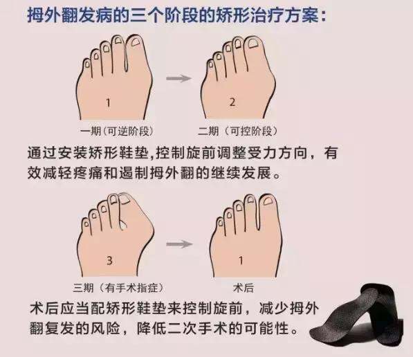 不适合穿尖头鞋,尖头鞋很容易将大拇指往内压,长时间下来,大拇指关节