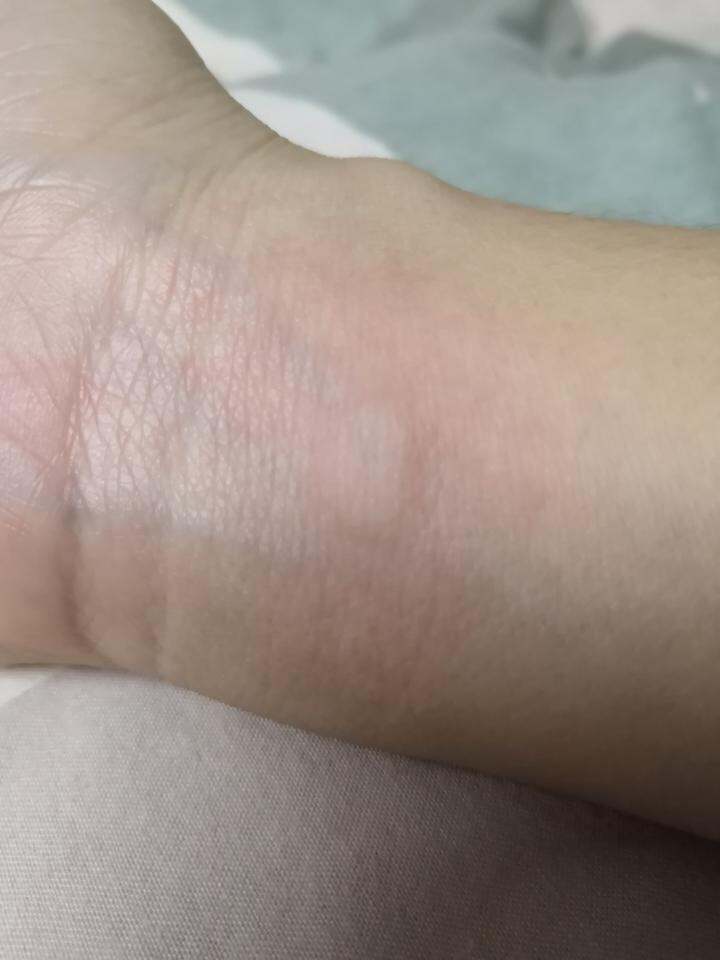 刚手腕被蚊子咬了个包