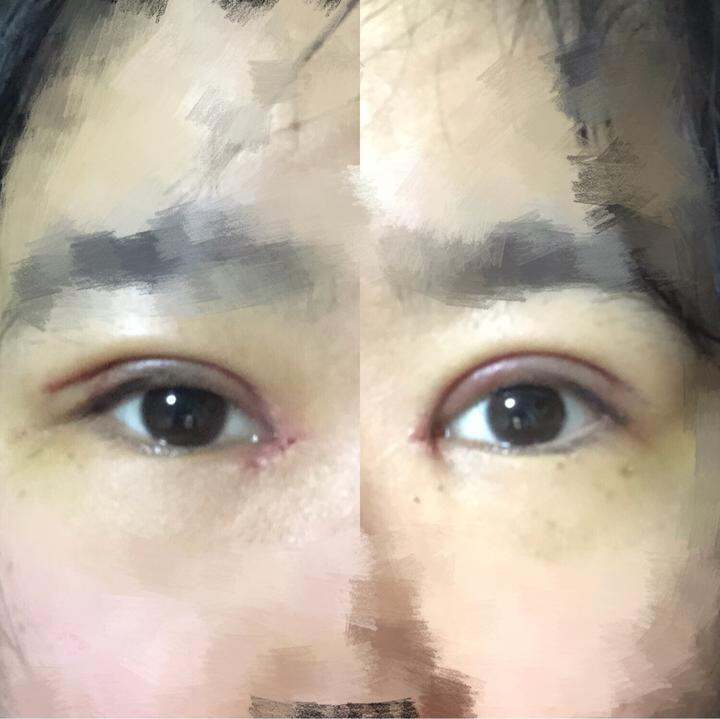 我这是第7天拆线开眼角了,我发现我左眼角和右眼角不一样啊,左眼角