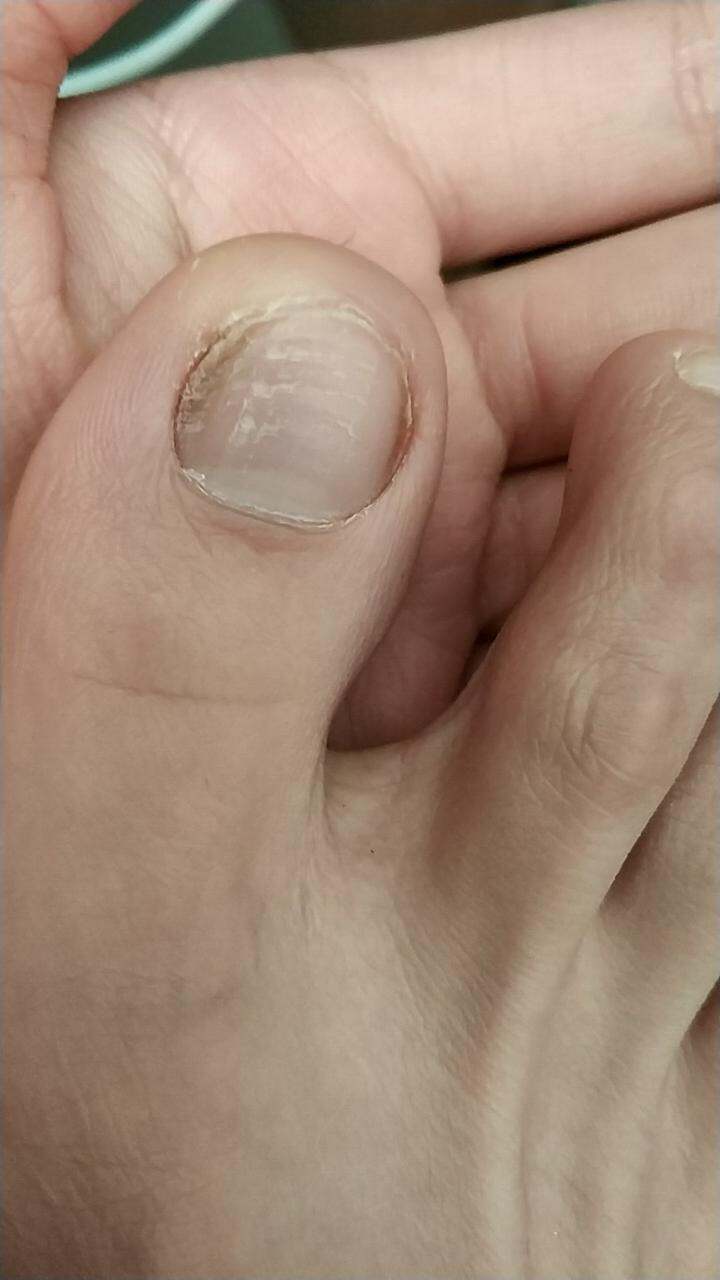 分享/甲沟炎 再也不用怕了