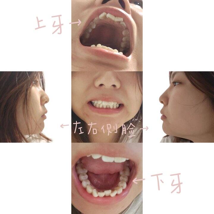 30岁，无锡周边牙齿矫正有推荐医生吗