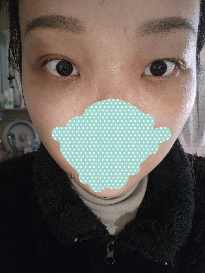 眼袋泪沟手术情况更新（附前后对比）