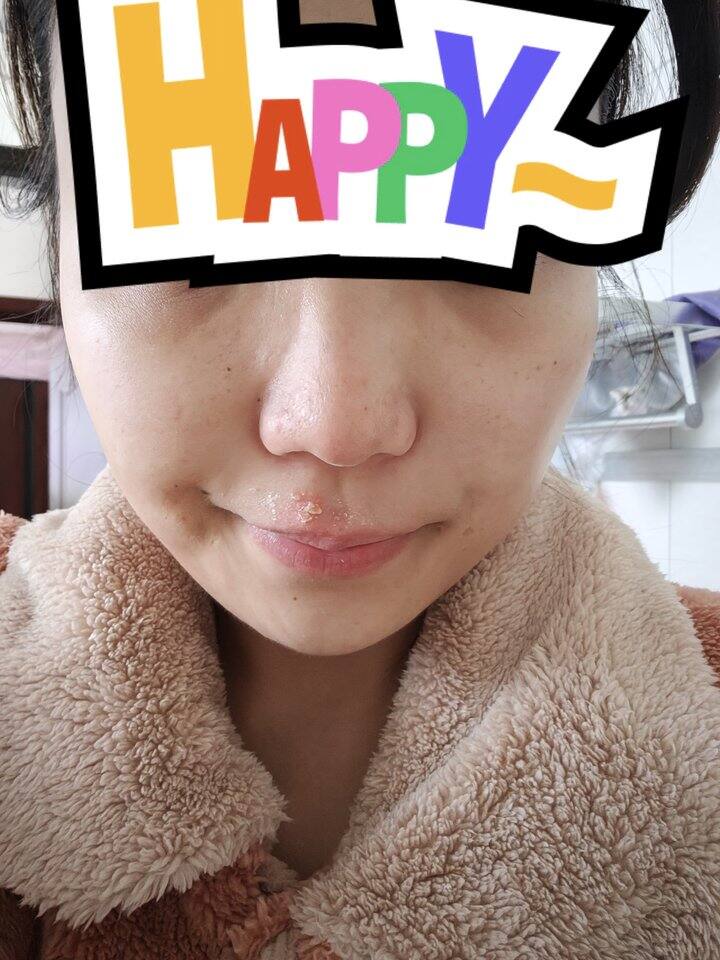 所有黑头明显的姐妹，行动起来（含对比图）