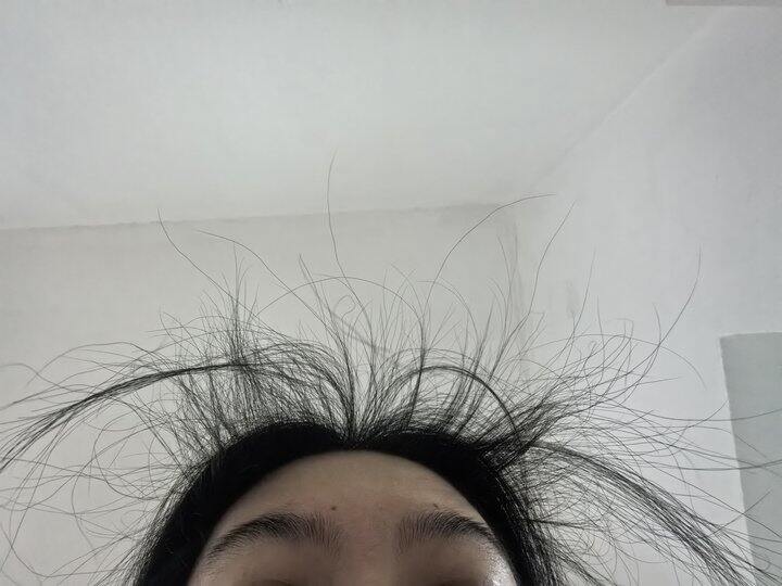 掉发焦虑的朋友们都去医院看看吧