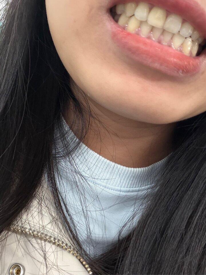 口呼吸造成的腺样体面容