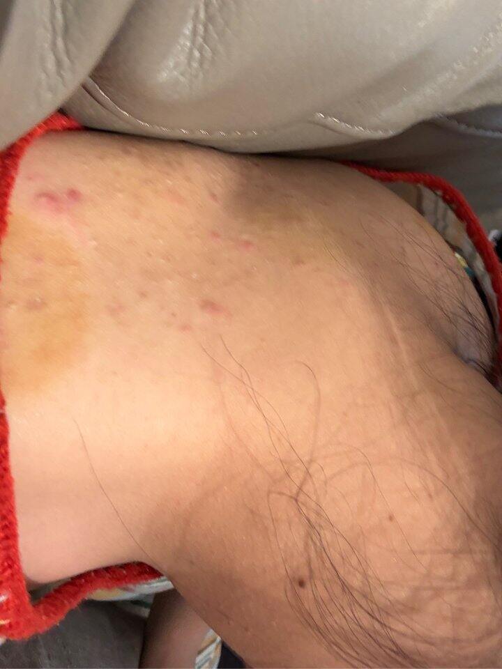求问 背上的痘痘怎么处理啊