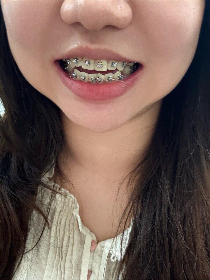 戴钢牙的第一天