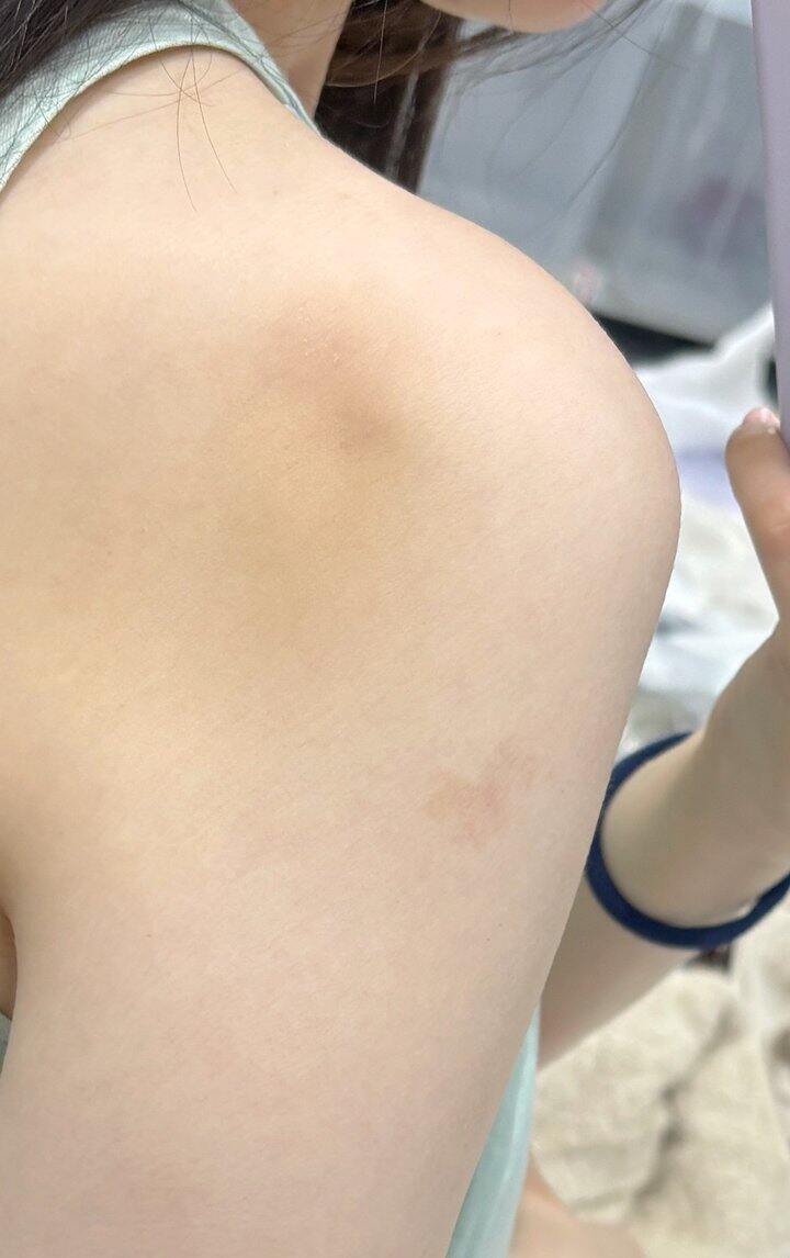 肩膀后面发黄怎么回事