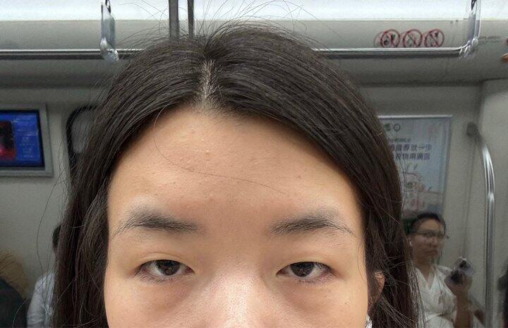 今天去割双眼皮了