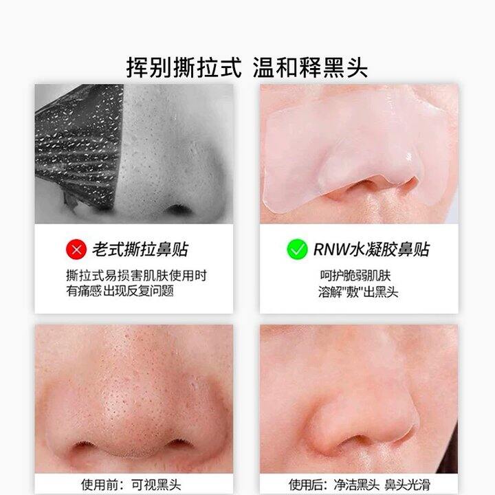 rnw鼻贴