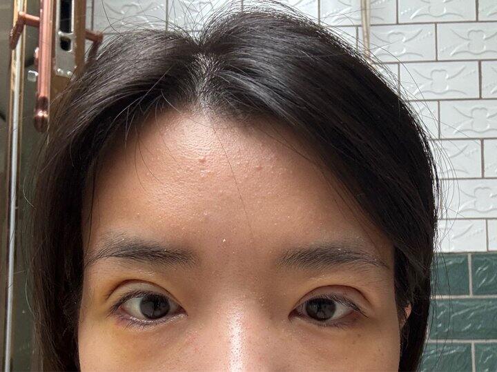 双眼皮第七天