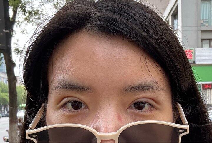 双眼皮第八天